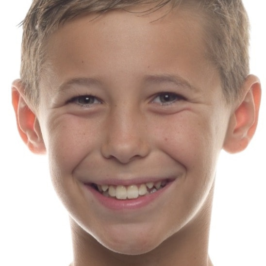 Orthodontic original smile alignment input